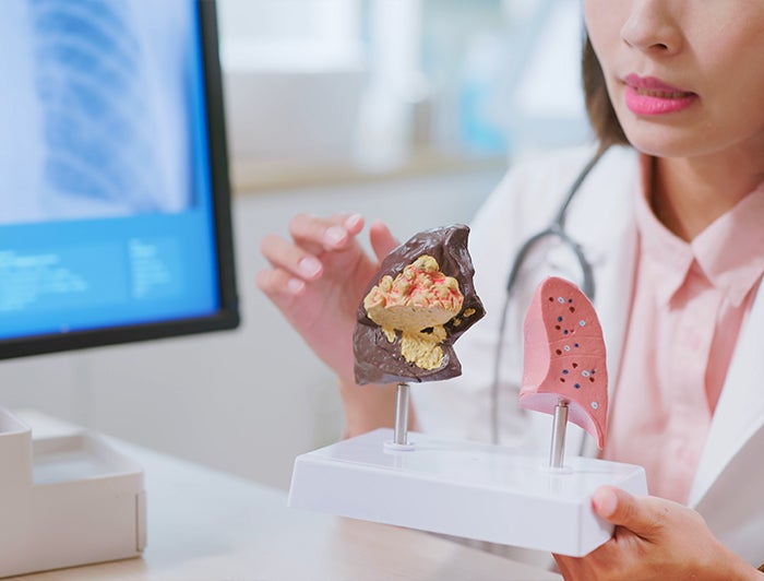 Stock image of a female clinician in white coat holding a model section of diseased lung and tumor
