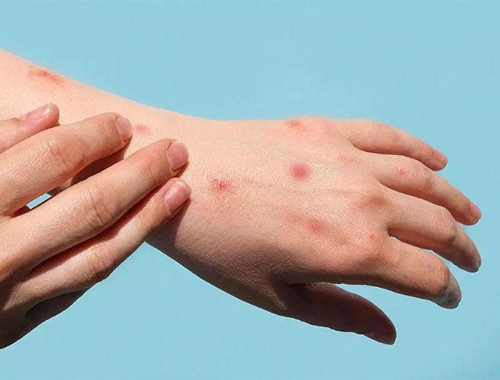 UW Medicine, Harborview Medical Center. stock image of hands covered in sores