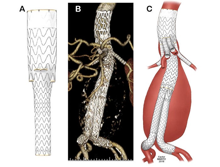 Intermountain Medical Center. Illustration and microscopicscan of aortic valve