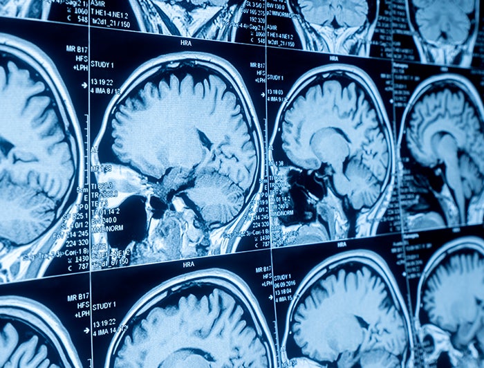 University of Rochester Medical Center. Stock image of a series of brain scans displayed on a viewing board
