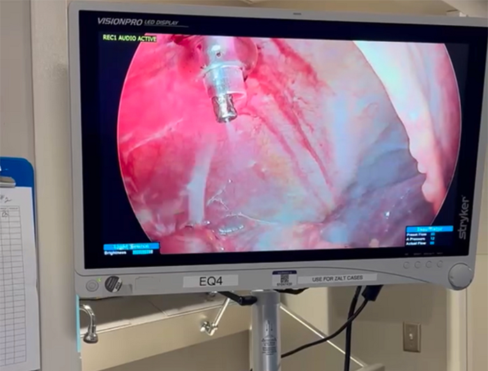 Henry Ford Health. Large monitor showing aerosolized chemo treatment in process