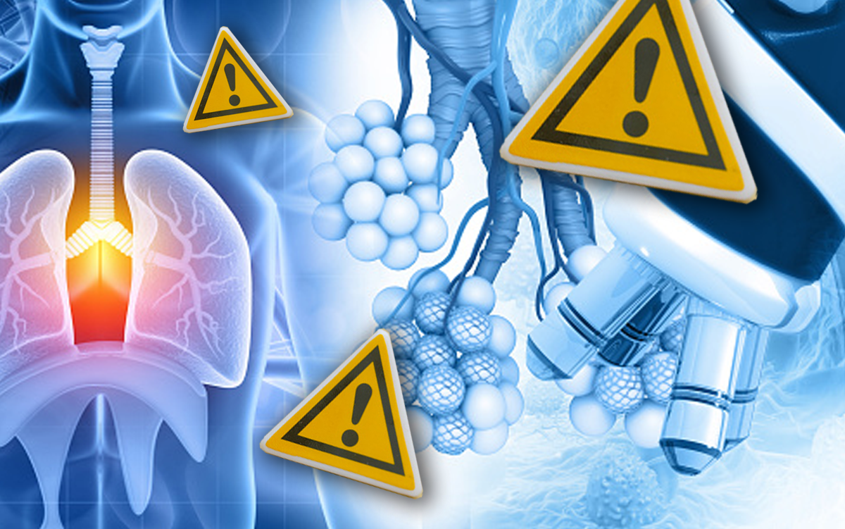 Epic Launches County-Level Health Alerts. Alert icons overlayed on images of a patient scan of lungs with acute bronchitis.